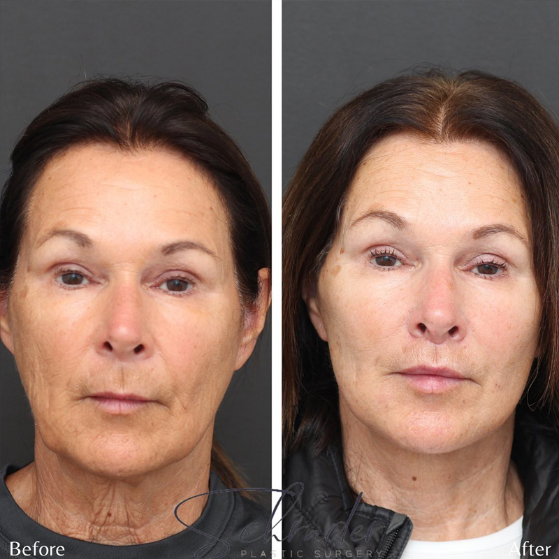 Before & After Photos Nicole Schrader, MD, FACS