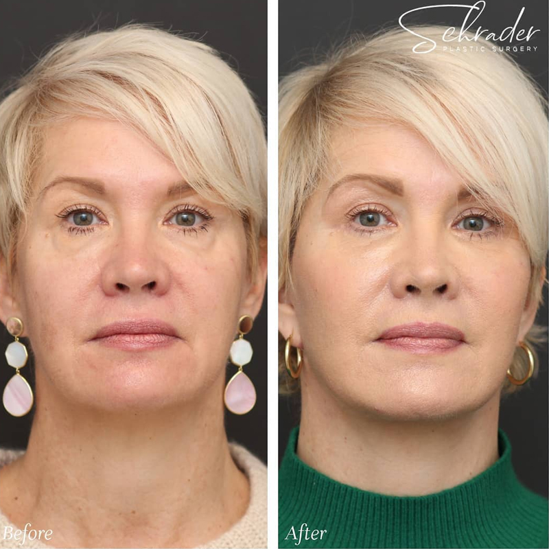 Before & After Photos Nicole Schrader, MD, FACS