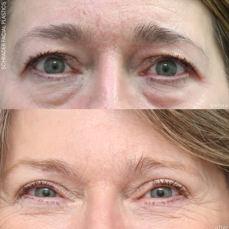 Before & After Photos Nicole Schrader, MD, FACS