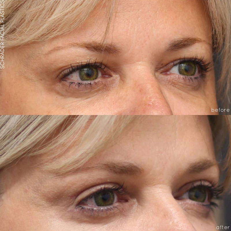 Before & After Photos Nicole Schrader, MD, FACS