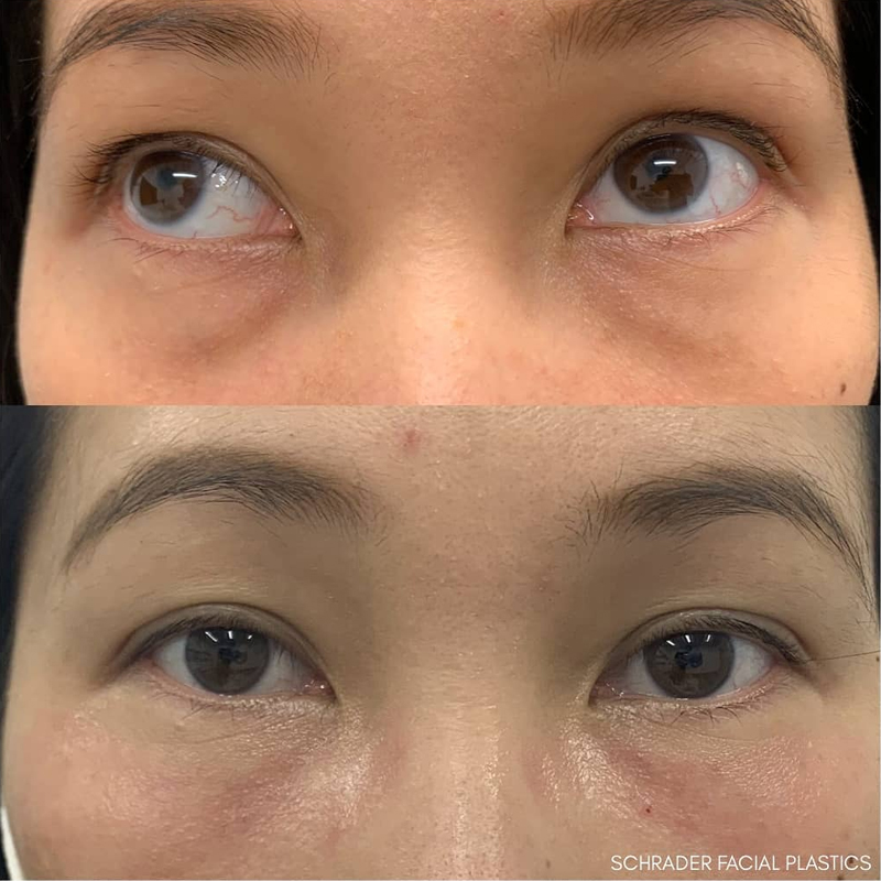 Before & After Photos Nicole Schrader, MD, FACS