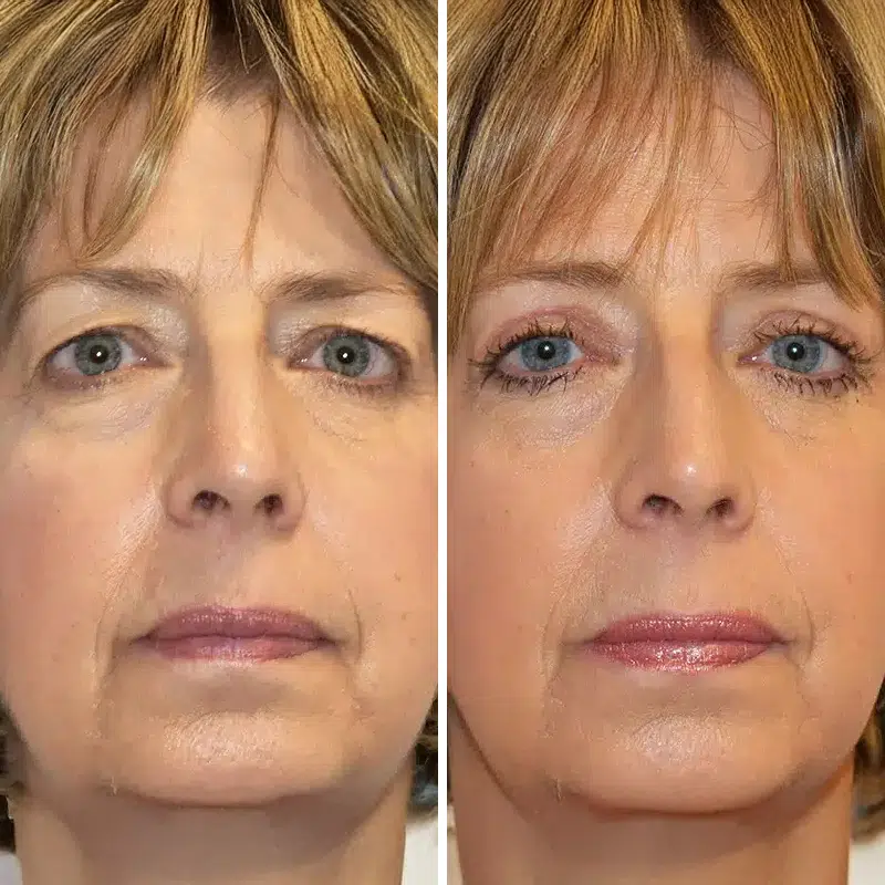 Before & After Photos Kirk Lozada, MD