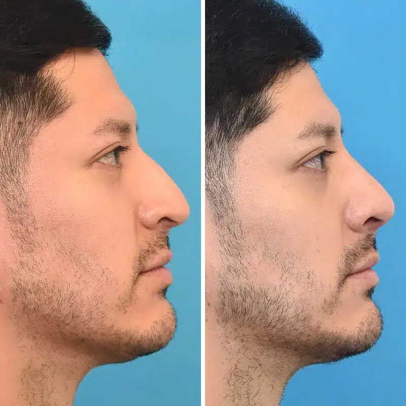 Before & After Photos Kirk Lozada, MD