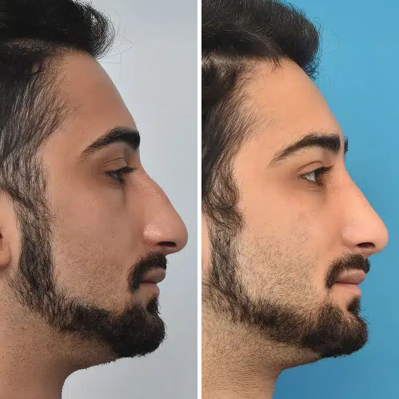 Before & After Photos Kirk Lozada, MD