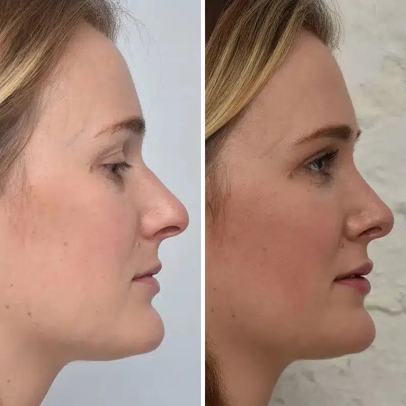 Before & After Photos Kirk Lozada, MD