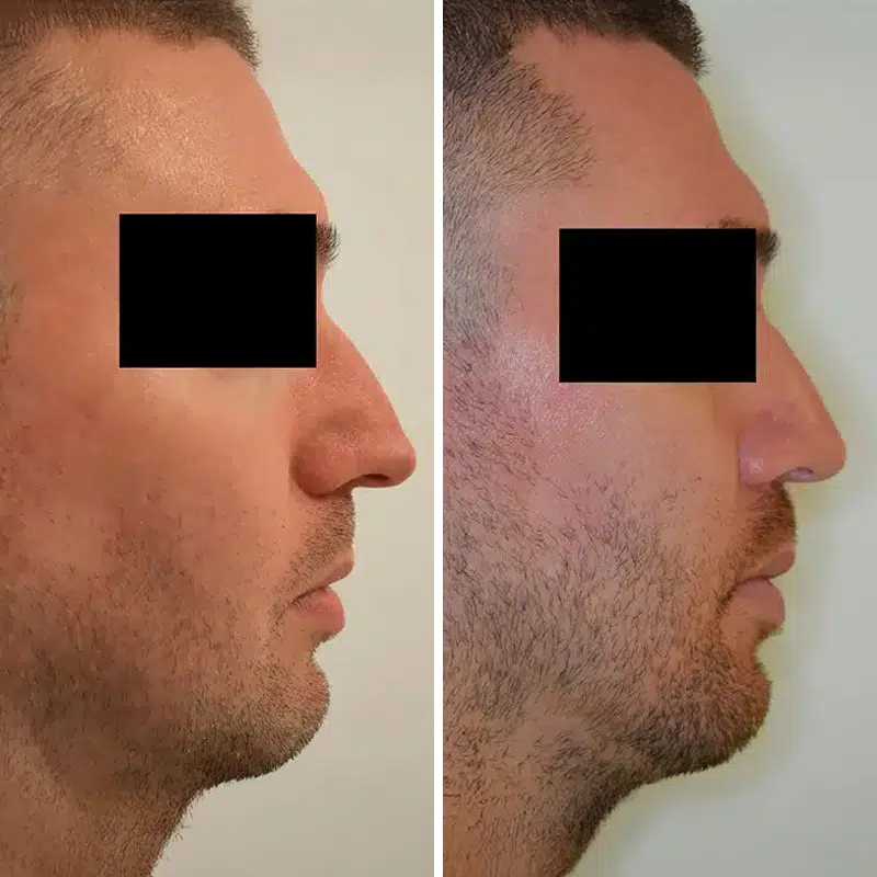 Before & After Photos Kirk Lozada, MD