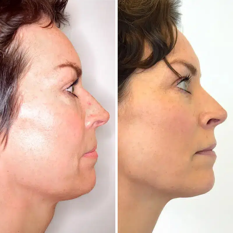 Before & After Photos Kirk Lozada, MD