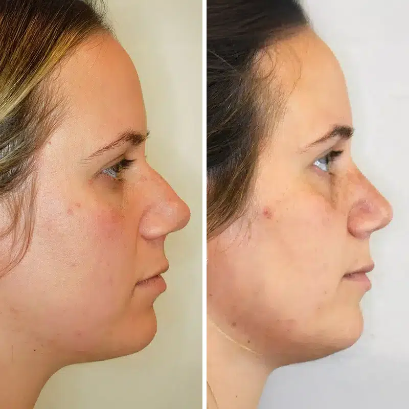 Before & After Photos Kirk Lozada, MD