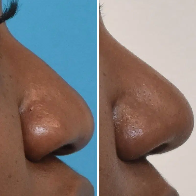 Before & After Photos Kirk Lozada, MD