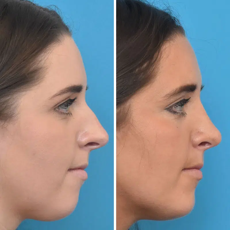 Before & After Photos Kirk Lozada, MD