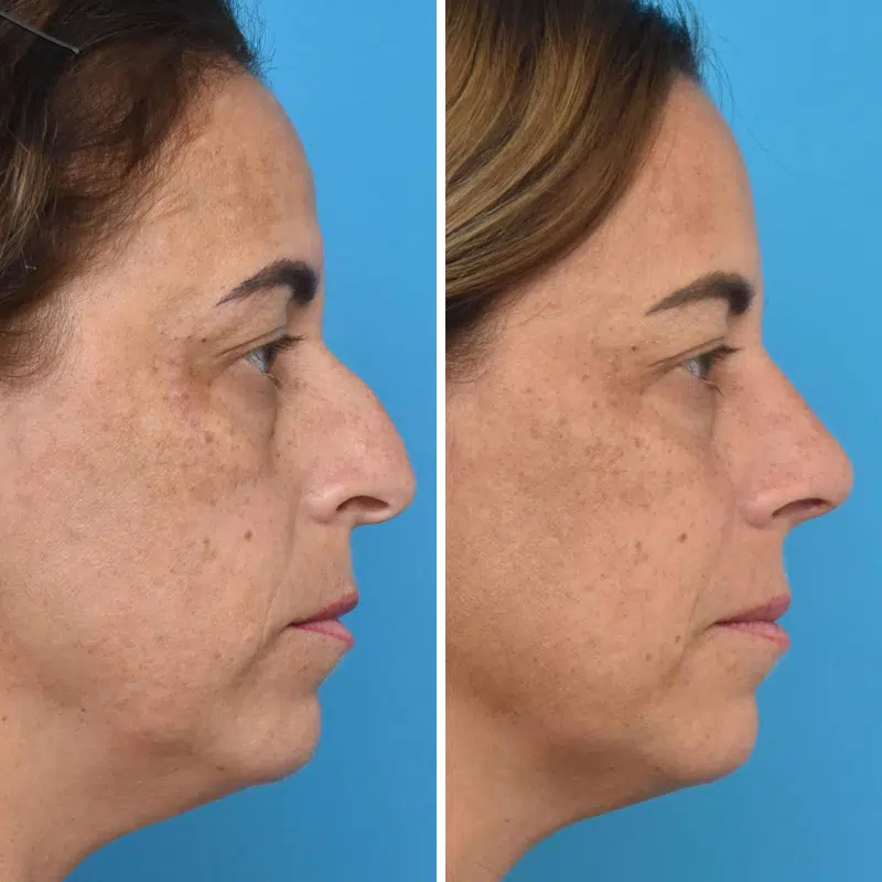 Before & After Photos Kirk Lozada, MD