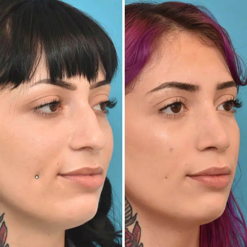 Before & After Photos Kirk Lozada, MD