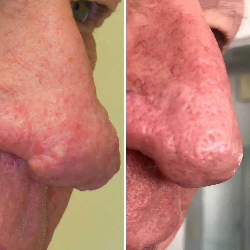 Before & After Photos Kirk Lozada, MD