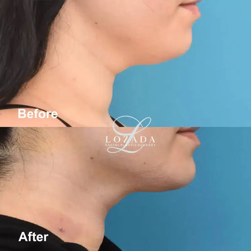 Before & After Photos Kirk Lozada, MD