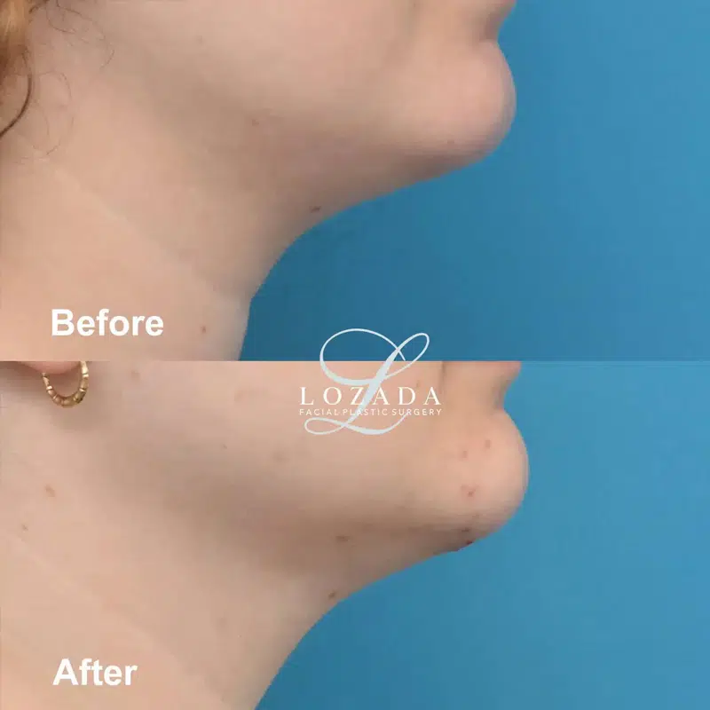 Before & After Photos Kirk Lozada, MD