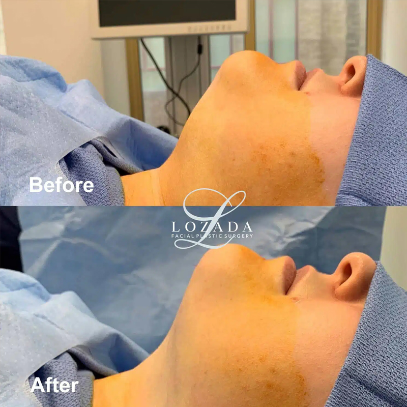 Before & After Photos Kirk Lozada, MD