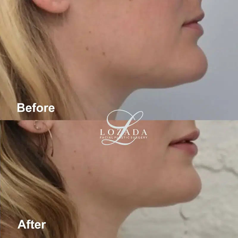 Before & After Photos Kirk Lozada, MD