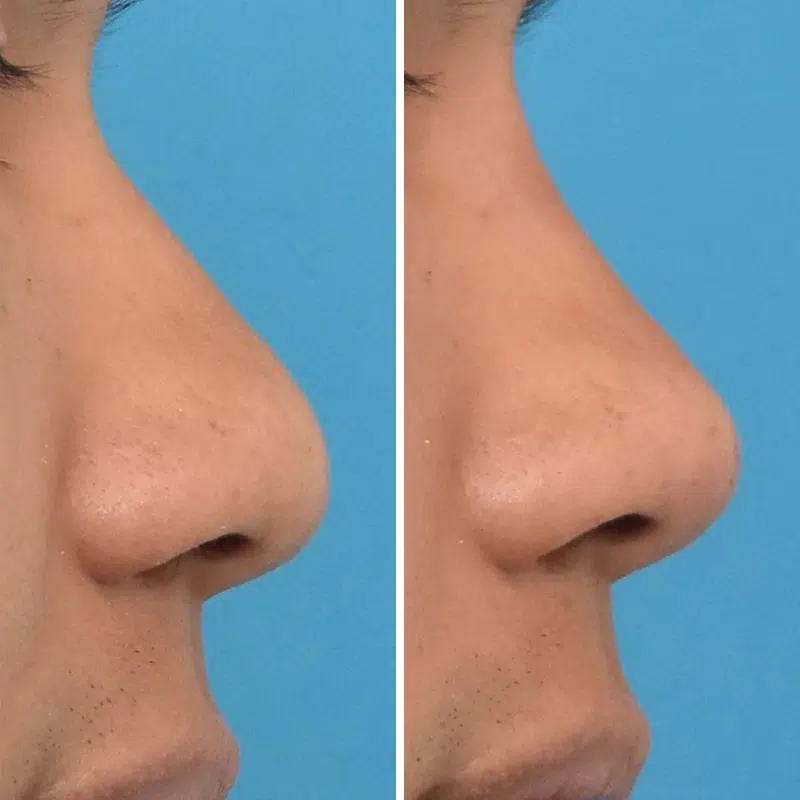 Before & After Photos Kirk Lozada, MD