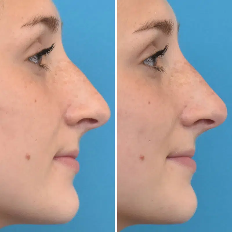 Before & After Photos Kirk Lozada, MD