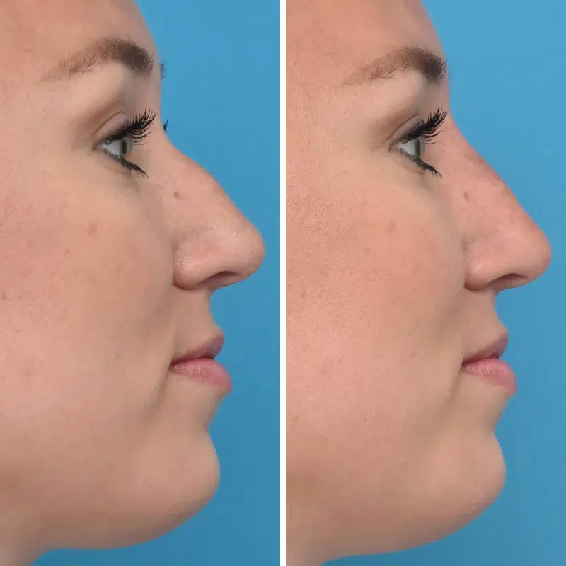 Before & After Photos Kirk Lozada, MD