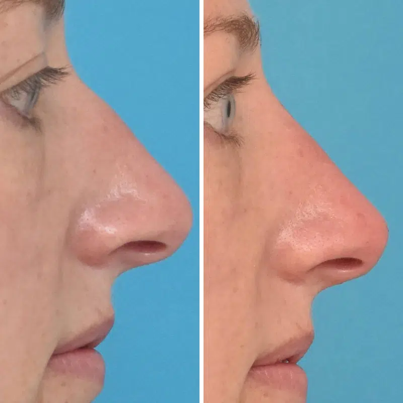 Before & After Photos Kirk Lozada, MD