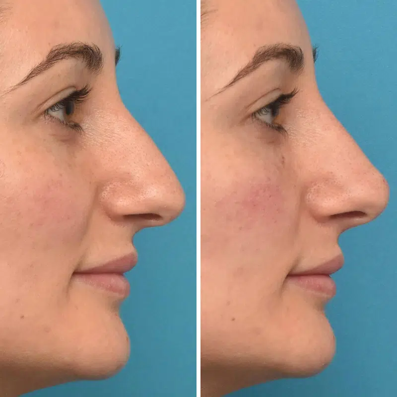 Before & After Photos Kirk Lozada, MD