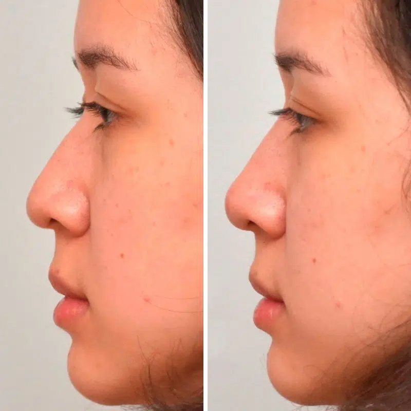 Before & After Photos Kirk Lozada, MD