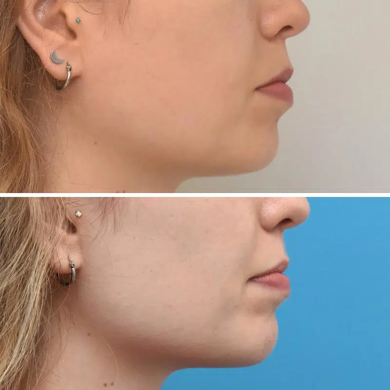 Before & After Photos Kirk Lozada, MD