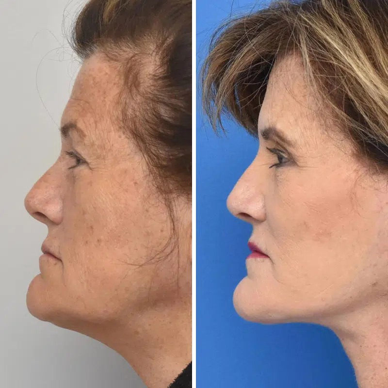 Before & After Photos Kirk Lozada, MD