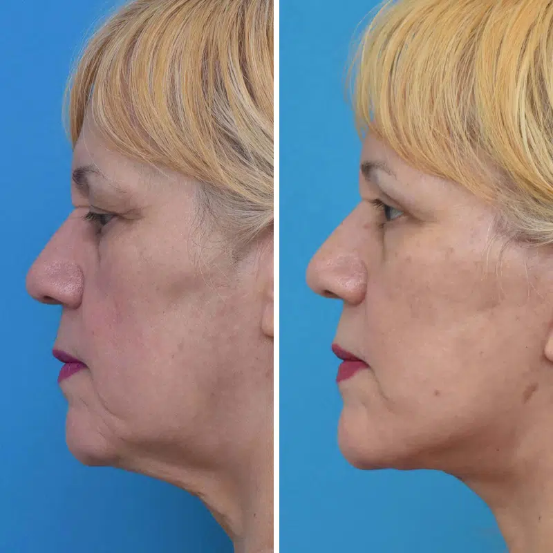 Before & After Photos Kirk Lozada, MD