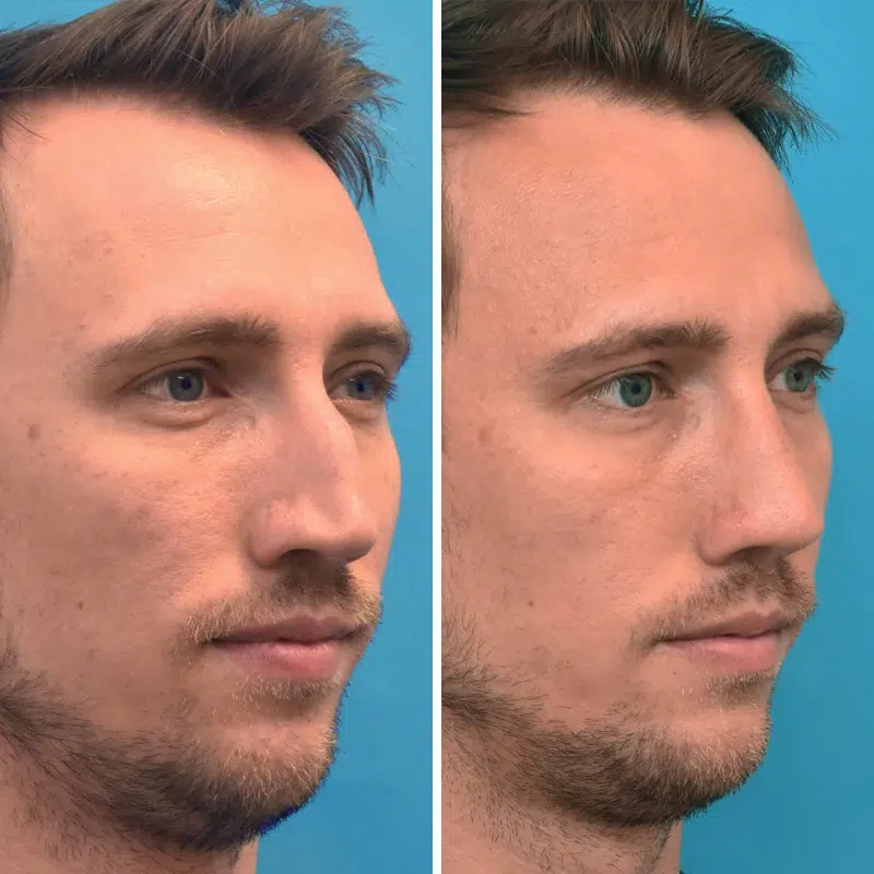 Before & After Photos Kirk Lozada, MD