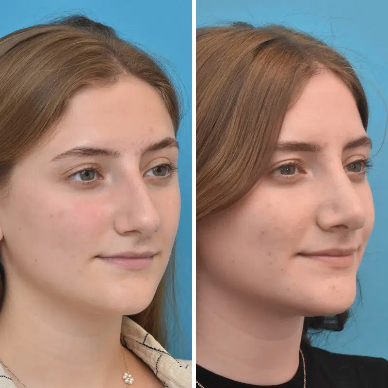 Before & After Photos Kirk Lozada, MD