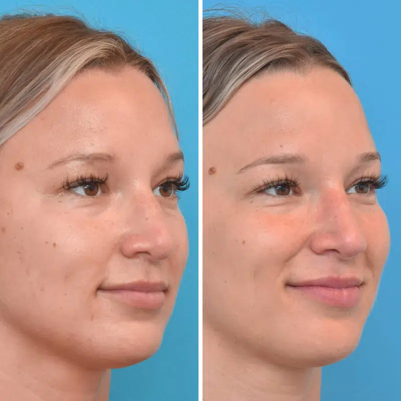 Before & After Photos Kirk Lozada, MD