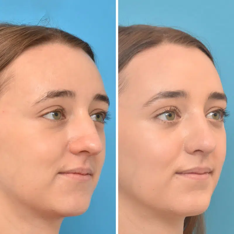 Before & After Photos Kirk Lozada, MD