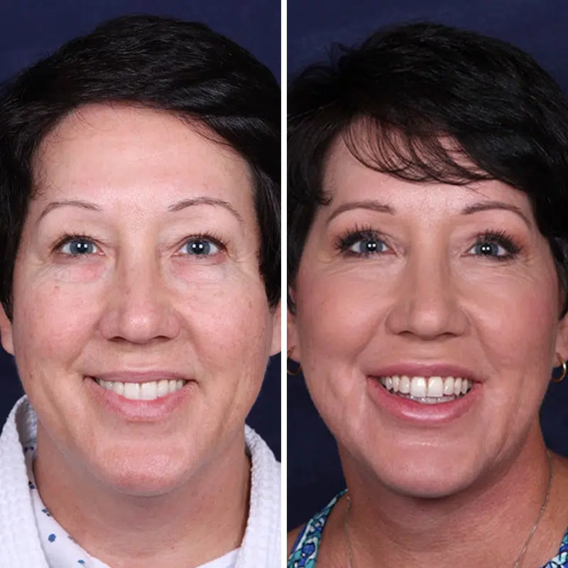 Before & After Photos Joanna Kam, MD