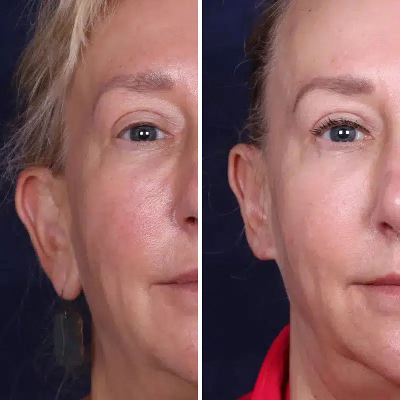 Before & After Photos Joanna Kam, MD