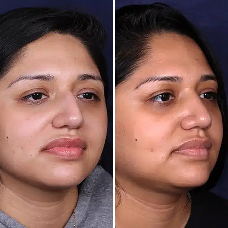 Before & After Photos Joanna Kam, MD