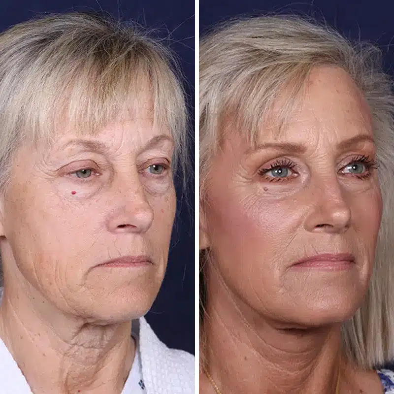 Before & After Photos Joanna Kam, MD