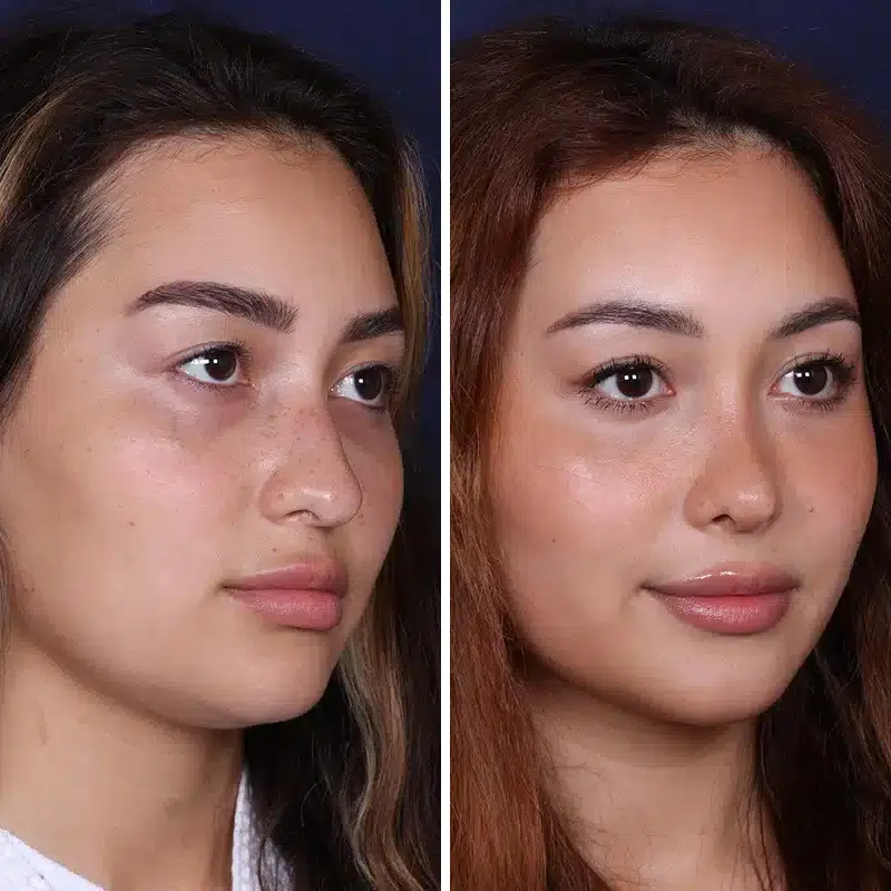 Before & After Photos Joanna Kam, MD