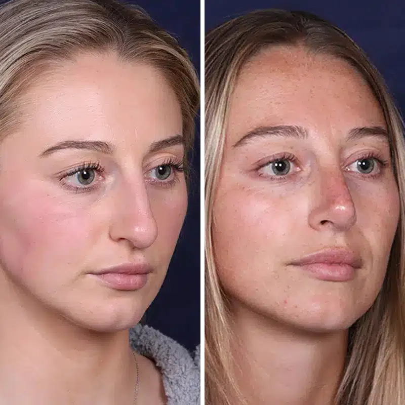 Before & After Photos Joanna Kam, MD