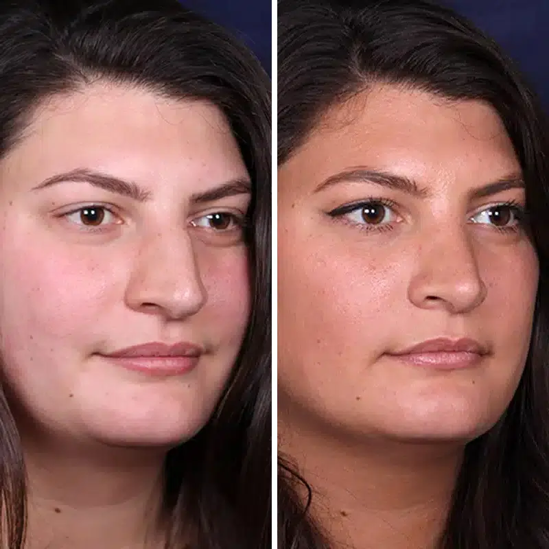 Before & After Photos Joanna Kam, MD