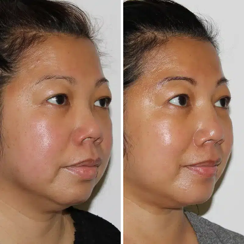 Before & After Photos Joanna Kam, MD