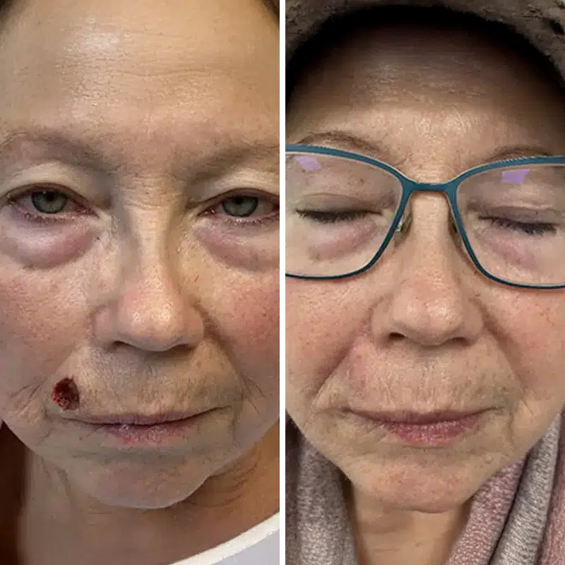 Before & After Photos Joanna Kam, MD