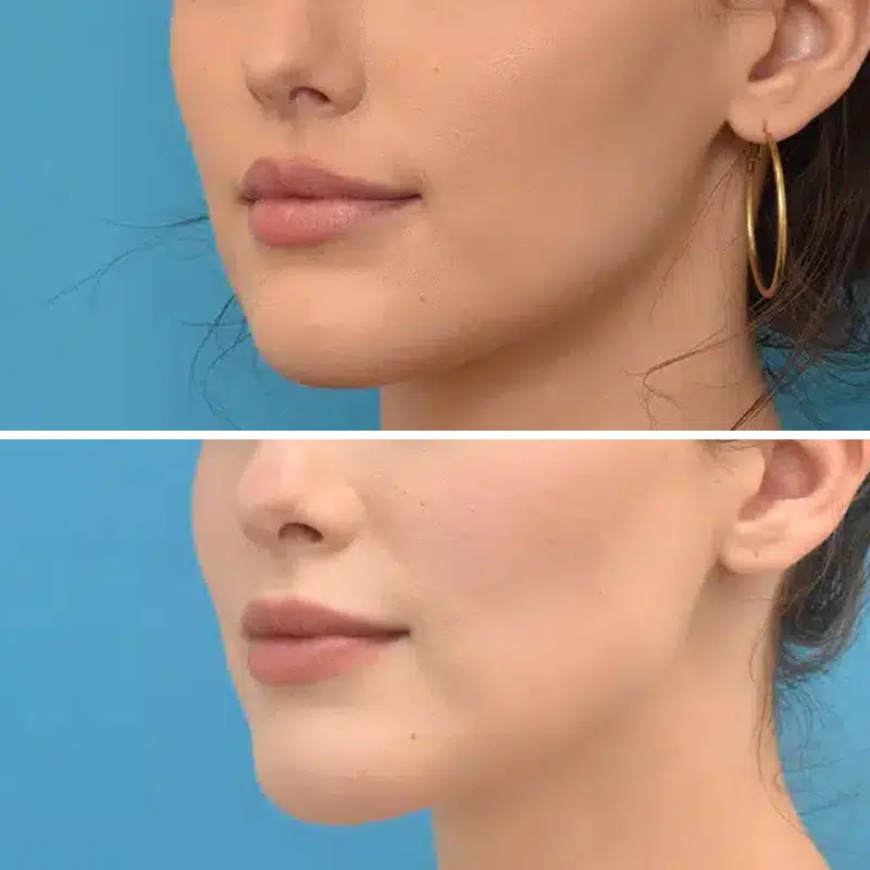 Before & After Photos Kirk Lozada, MD