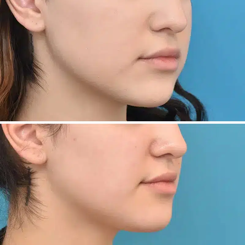 Before & After Photos Kirk Lozada, MD