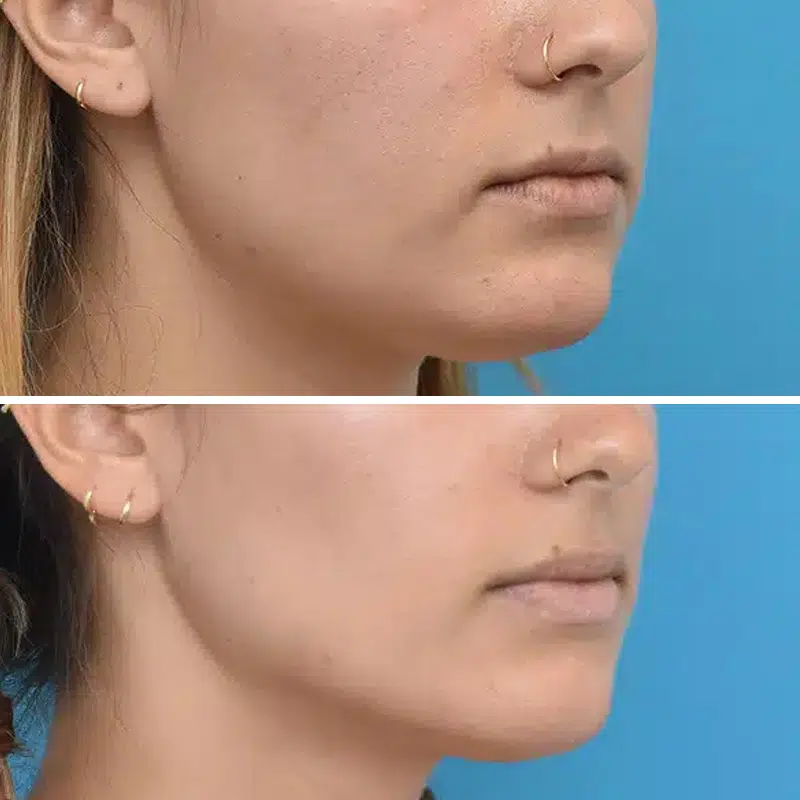 Before & After Photos Kirk Lozada, MD