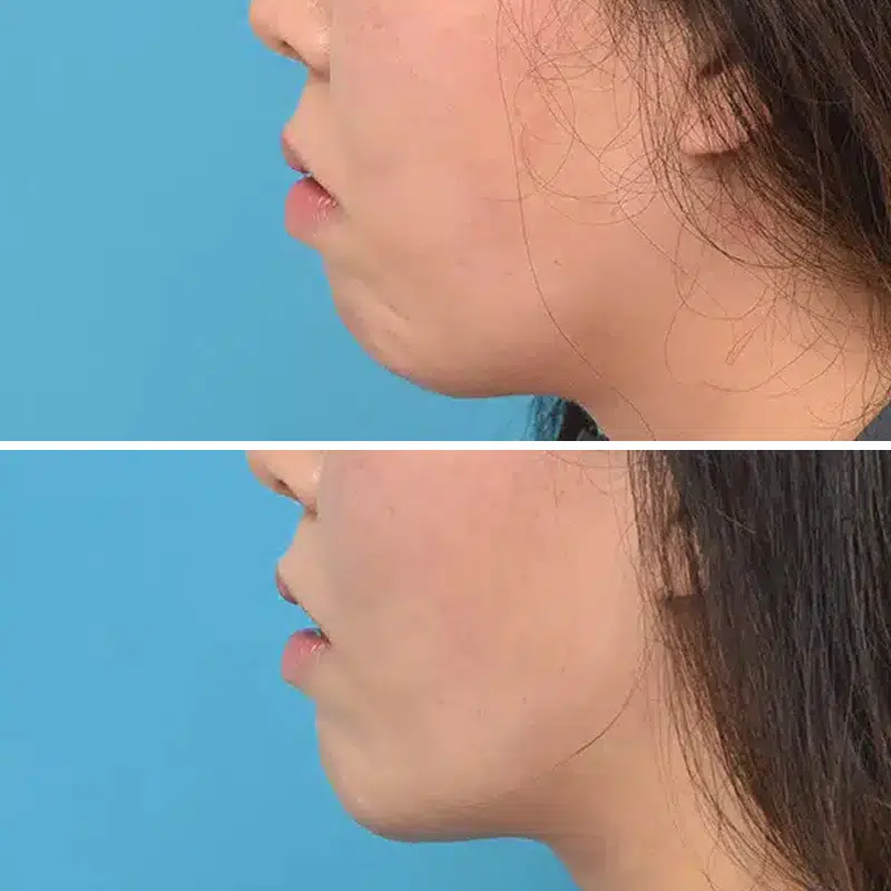 Before & After Photos Kirk Lozada, MD