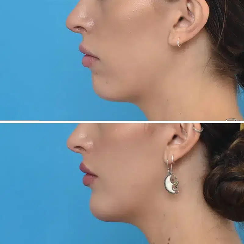 Before & After Photos Kirk Lozada, MD