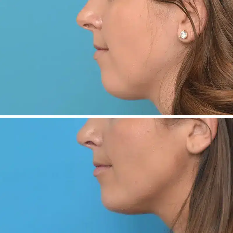 Before & After Photos Kirk Lozada, MD