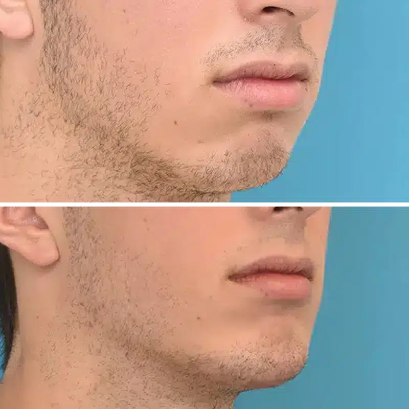 Before & After Photos Kirk Lozada, MD